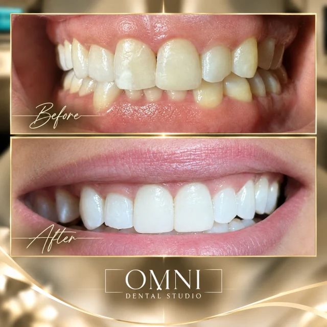Before and after photos of a real Omni Dental Studio patient. Before: upper front teeth with uneven color, white spots, and a dark gap. After: even, bright upper front teeth.