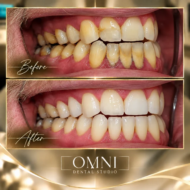 Before and after photos of a real Omni Dental Studio patient. Before: side view with yellow-brown buildup along the lower teeth and gumline. After: the same teeth clean and brighter.