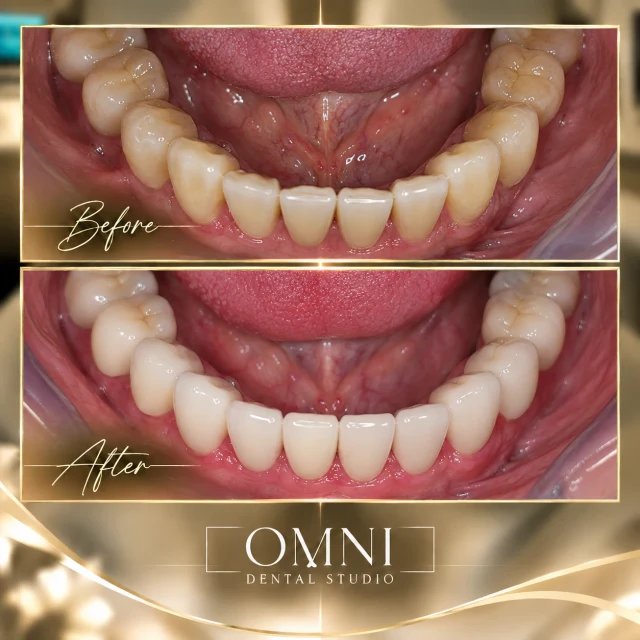 Before and after photos of a real Omni Dental Studio patient. Before: worn, yellowed lower front teeth seen from above. After: uniform, natural-looking lower teeth.