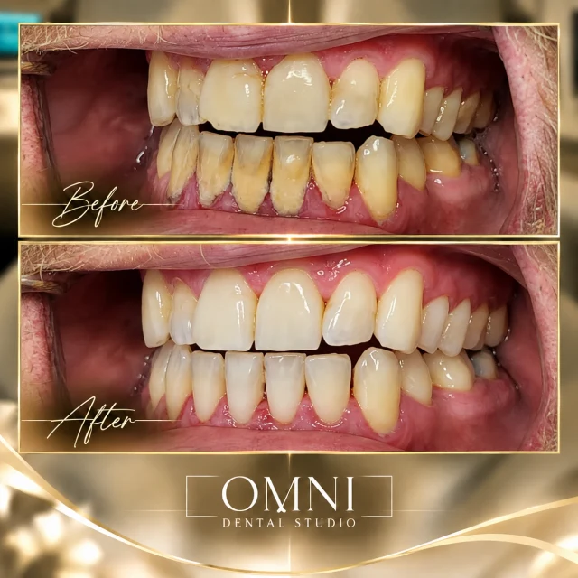 Before and after photos of a real Omni Dental Studio patient. Before: heavy yellow buildup on the lower front teeth. After: clean lower teeth and healthier-looking gums.
