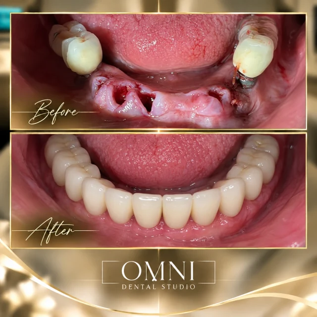Before and after photos of a real Omni Dental Studio patient. Before: a lower arch with missing front teeth and healing gums. After: a complete, even row of lower teeth.