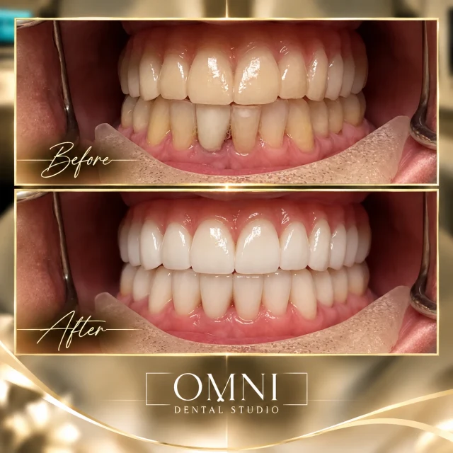 Before and after photos of a real Omni Dental Studio patient. Before: discolored, uneven lower teeth behind the upper teeth. After: bright, even upper and lower teeth.