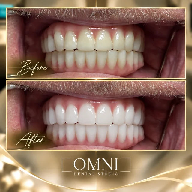 Before and after photos of a real Omni Dental Studio patient. Before: yellowish upper and lower teeth. After: brighter, whiter teeth.