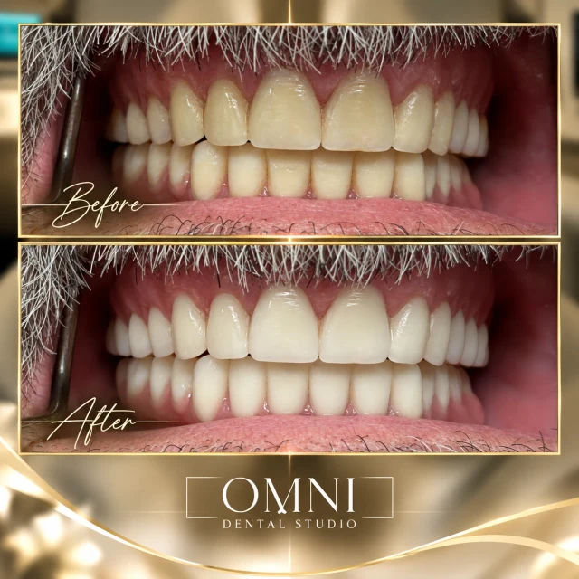 Before and after photos of a real Omni Dental Studio patient. Before: yellowed upper front teeth. After: brighter, more even upper teeth.