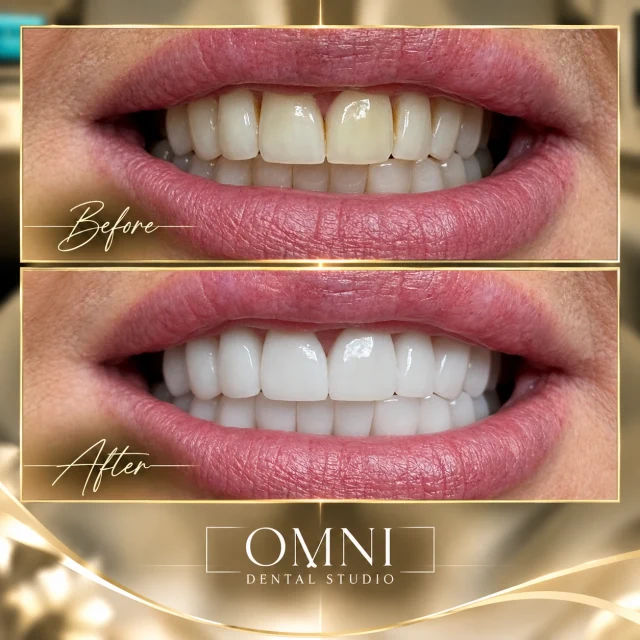 Before and after photos of a real Omni Dental Studio patient. Before: two darker upper front teeth in a smile. After: bright, uniform upper front teeth.