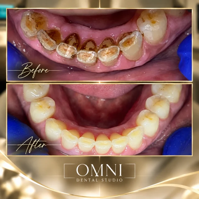 Before and after photos of a real Omni Dental Studio patient. Before: heavily worn and stained lower teeth seen from above. After: cleaner, smoother-looking lower teeth.