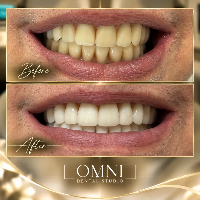 Before and after photos of a real Omni Dental Studio patient. Before: yellowed upper teeth in a smile. After: bright, even upper teeth.