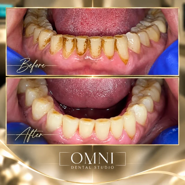 Before and after photos of a real Omni Dental Studio patient. Before: brown stain along the lower teeth seen from above. After: clean lower teeth.