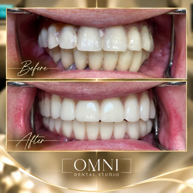 Before and after photos of a real Omni Dental Studio patient. Before: upper teeth with staining and uneven edges. After: bright, even upper and lower teeth.