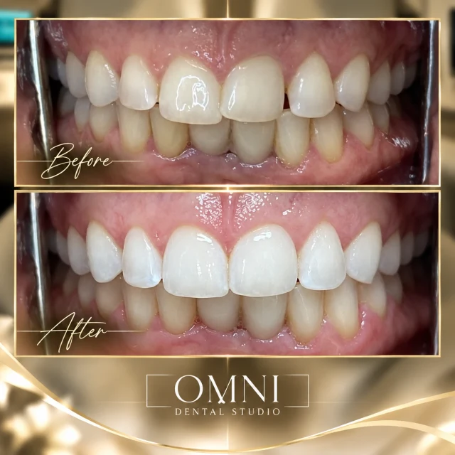 Before and after photos of a real Omni Dental Studio patient. Before: upper front teeth with worn edges and small gaps. After: even, bright upper front teeth.