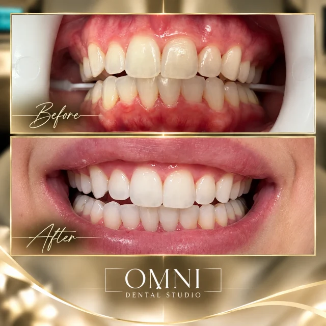 Before and after photos of a real Omni Dental Studio patient. Before: upper and lower teeth with a yellow tone. After: a brighter, even smile.