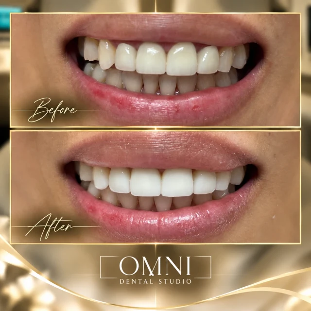 Before and after photos of a real Omni Dental Studio patient. Before: uneven, yellowish upper teeth in a smile. After: bright, even upper teeth.