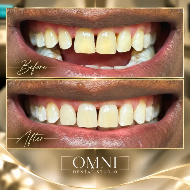 Before and after photos of a real Omni Dental Studio patient. Before: gaps between the upper front teeth. After: more even upper front teeth with smaller gaps.