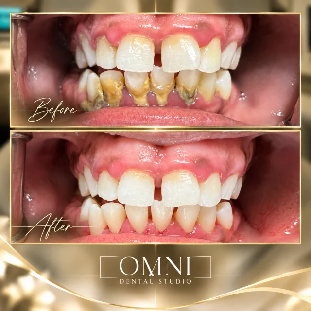 Before and after photos of a real Omni Dental Studio patient. Before: heavy buildup on the lower front teeth. After: clean lower front teeth.